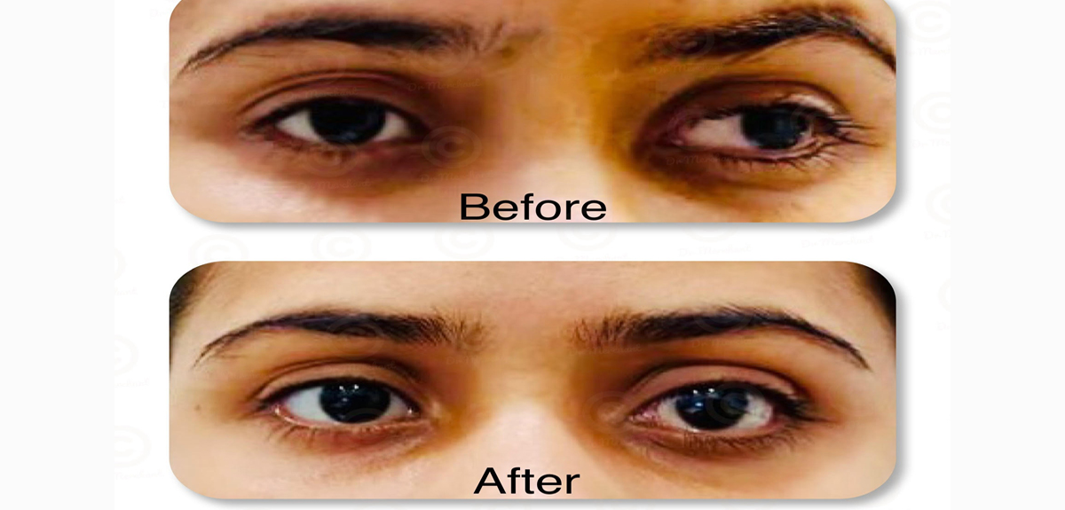 Squint Treatment in Andheri west